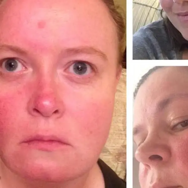 17 Things People With Rosacea Wish You Understood