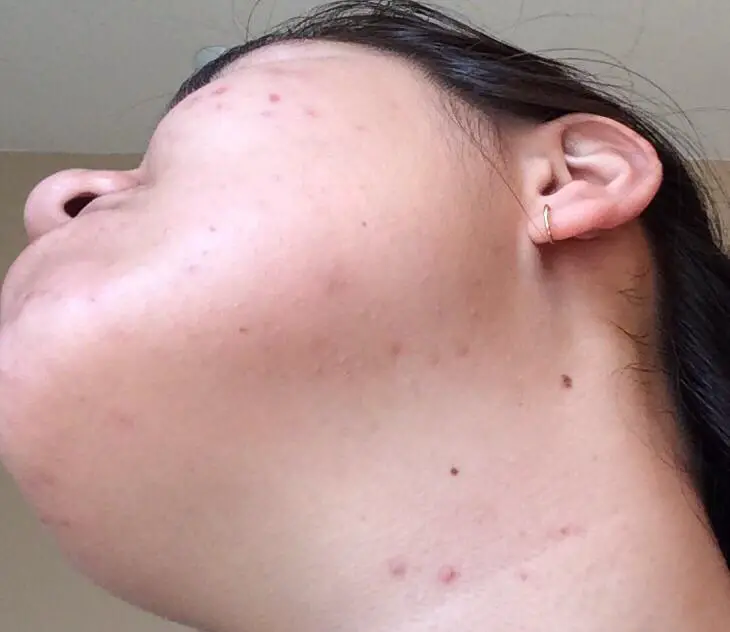 [Acne] Im getting closed comedones and blackheads along my jawline ...