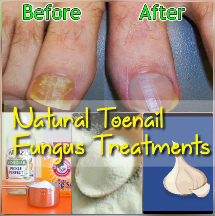 Best Home Remedies To Get Rid Of Toenail Fungus Fast
