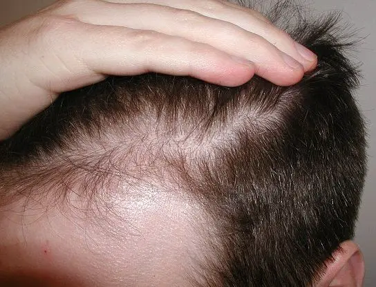 Can Mold Cause Hair Loss
