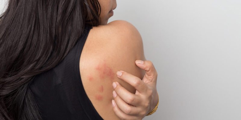 Can Mold Cause Hives