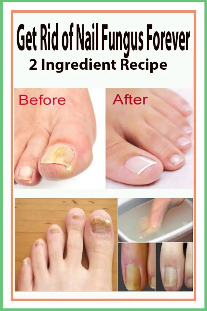 Get Rid of Nail Fungus Forever â 2 Ingredient Recipe