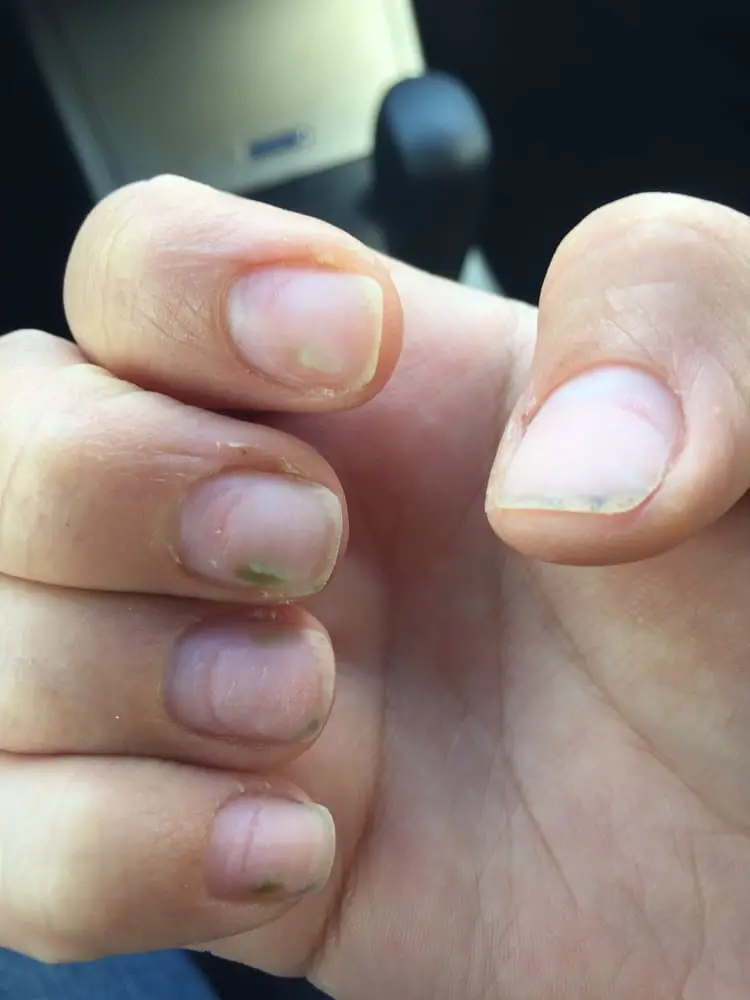 green fungus on my nail after removing the acrylic!
