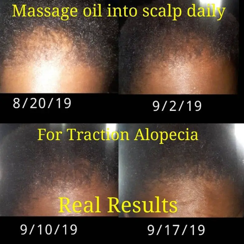 Hair Growth OIL BALD spots Traction Alopecia Thin Edges