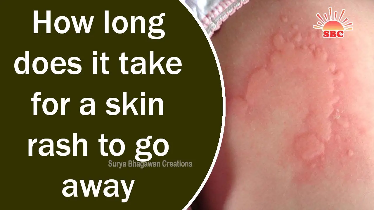 How long does it take for a skin rash to go away
