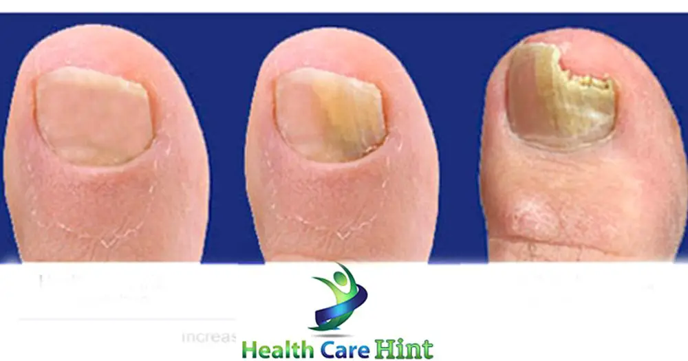 How to remove fungus on nails by easy home remedies