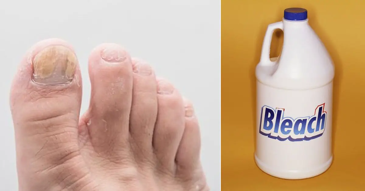 How to Remove Toenail Fungus With Bleach + Prevention Tips