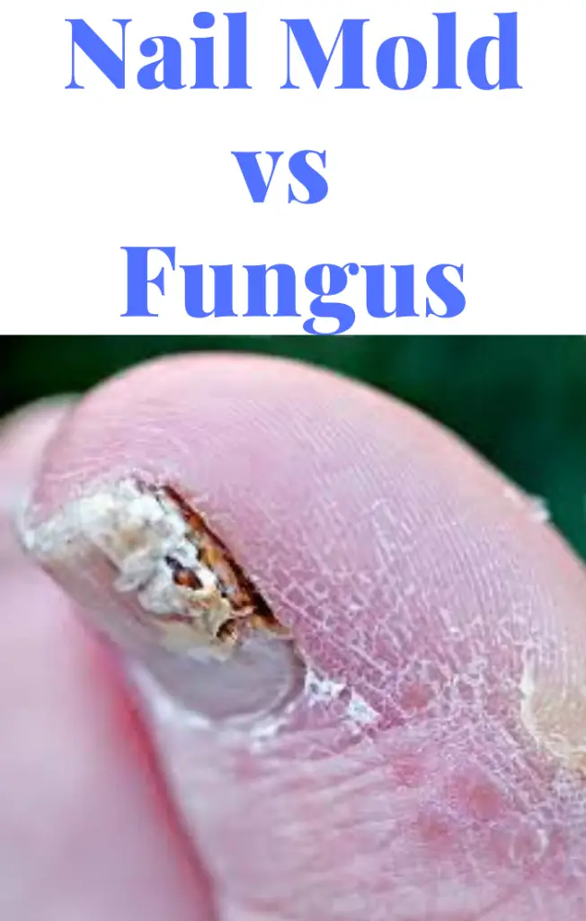 Nail Mold vs Fungus: Differences, Symptoms, Causes...Inside