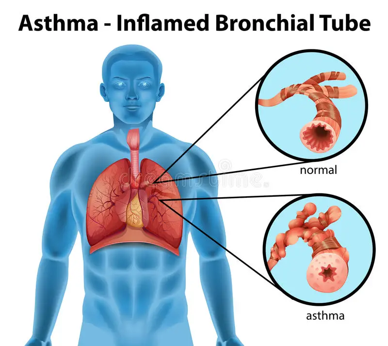 Tube Bronchique Asthme